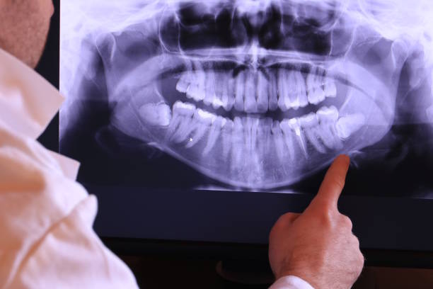 Best Emergency Dental Extractions in Avon, OH