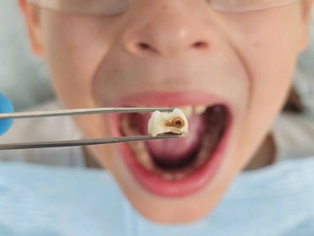 Best Emergency Dentist for Lost Fillings or Crowns in Avon, OH
